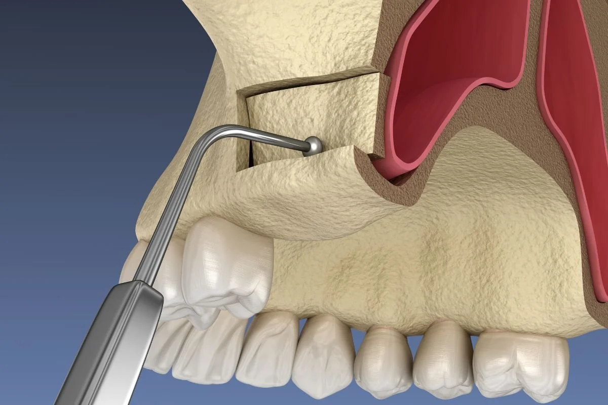 Sinus Lifts | Emerald Coast Periodontics